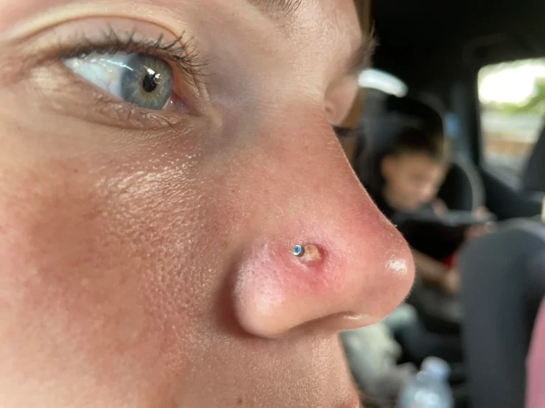 Dealing with Nose Piercing Bumps: A Complete Guide