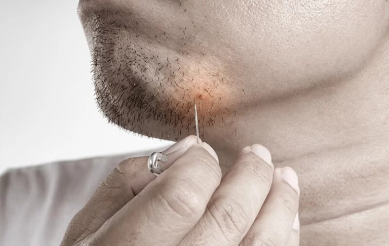 Understanding Ingrown Hairs: Causes, Symptoms, and Solutions