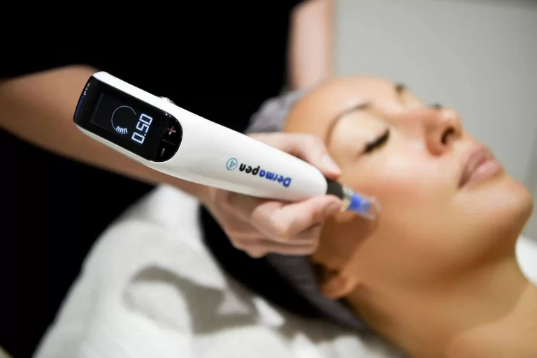 SkinPen Microneedling: The Innovative Solution to Combat Facial Acne Scars