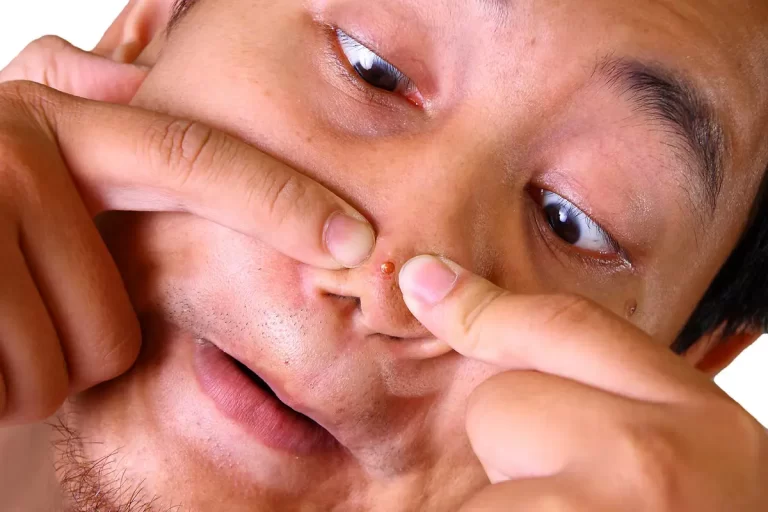 Pimple Popping Secrets: Why Dermatologists Are the Experts