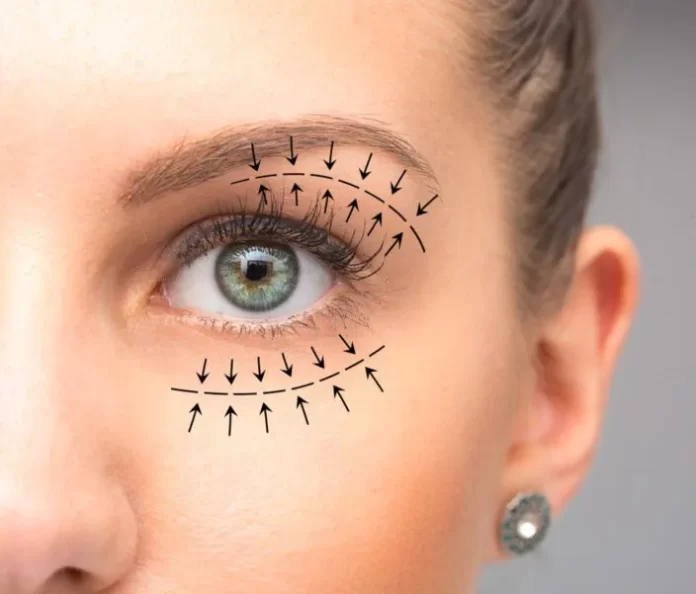 Blepharoplasty: A Comprehensive Guide to Eye Lift Surgery