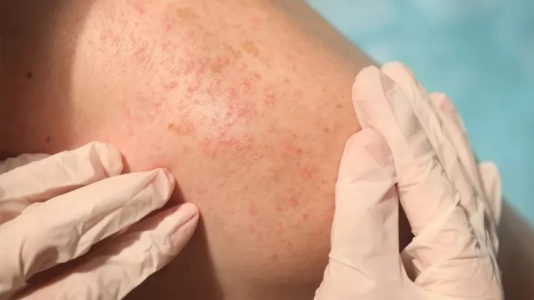 Exploring the Connection Between Hepatitis C and Skin Reactions