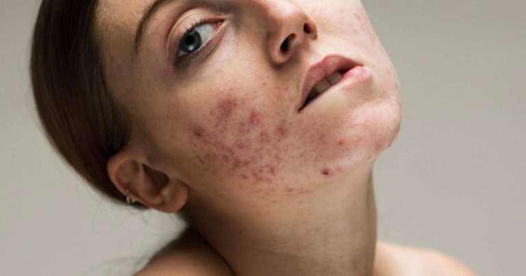 Nurturing Your Skin: A Comprehensive Guide to Common Skin Problems