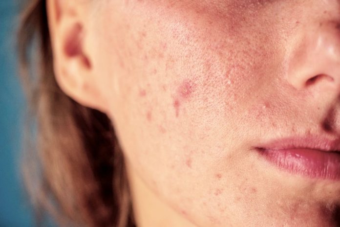 Keeping Acne at Bay: Your Guide to Managing Summertime Breakouts