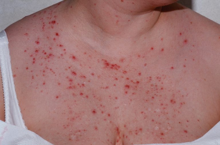 Folliculitis Unveiled: Understanding and Managing Skin Bumps