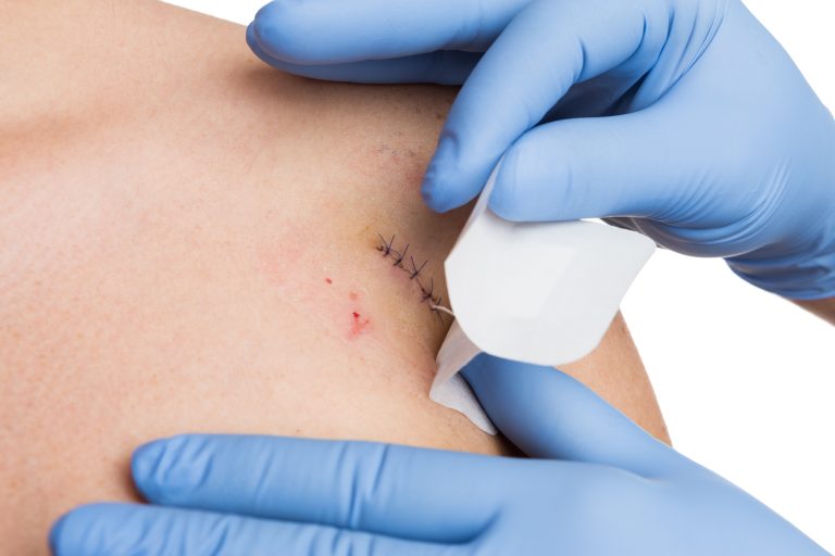 Taking Care After Removing Stitches: A Guide to a Speedy Recovery