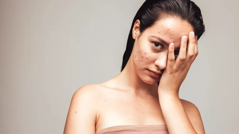 Dealing with Autumn Acne: Tips for a Clearer Complexion