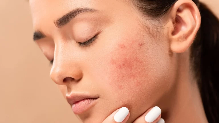 Hormones and Beautiful Skin: Unlocking the Secrets