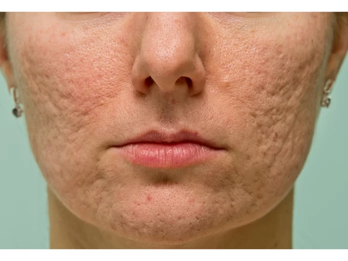 The Dermatologist's Guide to Harnessing Collagen Stimulating Skin Fillers for Scar Reduction and Anti-Aging Benefits The Dermatologist's Guide to Harnessing Collagen Stimulating Skin Fillers for Scar Reduction and Anti-Aging Benefits