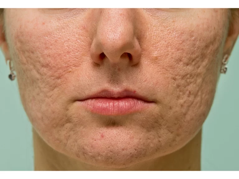 The Dermatologist’s Guide to Harnessing Collagen Stimulating Skin Fillers for Scar Reduction and Anti-Aging Benefits