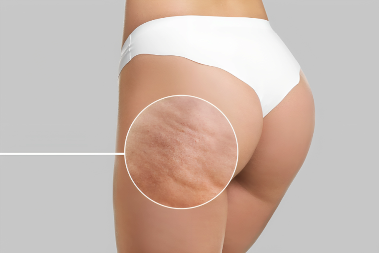 Say Goodbye to Cellulite with Cellfina: The Revolutionary Treatment You Need to Know About