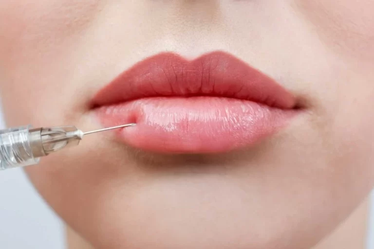 The Rise in Popularity of Calcium Hydroxyapatite Fillers in Dermatology