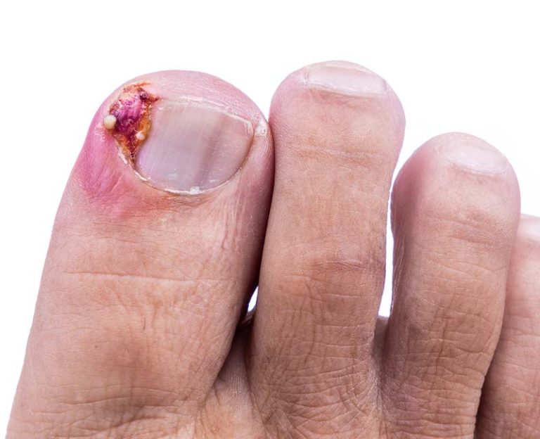 Unveiling the Power of Fungal Nail Clarifying Gel: A Comprehensive Guide