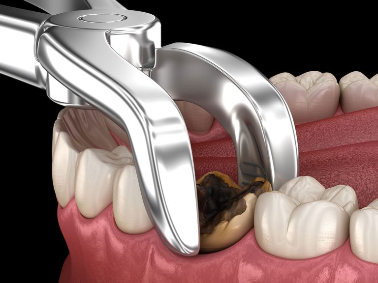 Expert Insights: Dermatologist’s Guide to Wisdom Teeth Removal and Oral Health