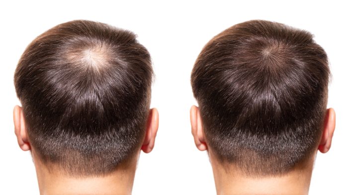 Unveiling NeoGraft Hair Transplants: A Revolutionary Approach to Hair Restoration