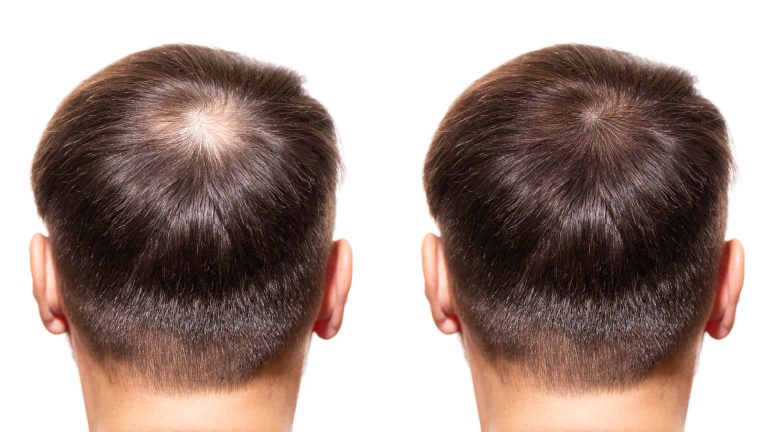 Unveiling NeoGraft Hair Transplants: A Revolutionary Approach to Hair Restoration