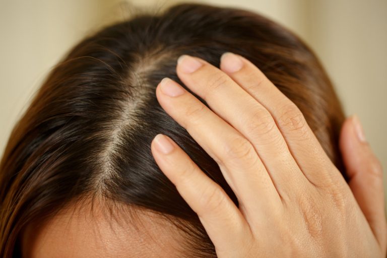 Conquer Dry, Flaky, and Itchy Scalp Woes: Understanding Causes and Simple Home Remedies