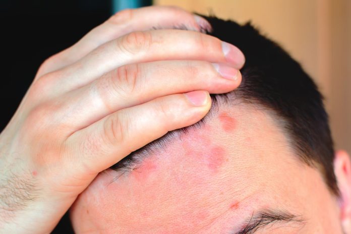 Treating Rare Skin Diseases by Transplanting Healthy Skin: A Revolutionary Approach