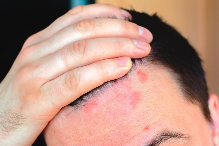 Treating Rare Skin Diseases by Transplanting Healthy Skin: A Revolutionary Approach