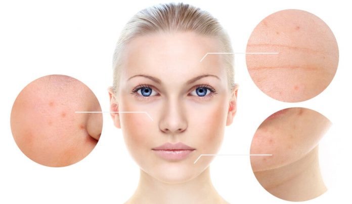 The 5 Top Benefits of Chemical Peels