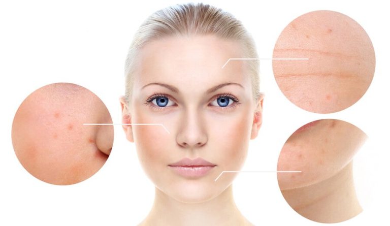 The 5 Top Benefits of Chemical Peels