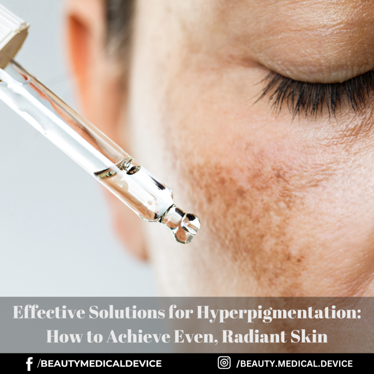 Effective Solutions for Hyperpigmentation: How to Achieve Even, Radiant Skin
