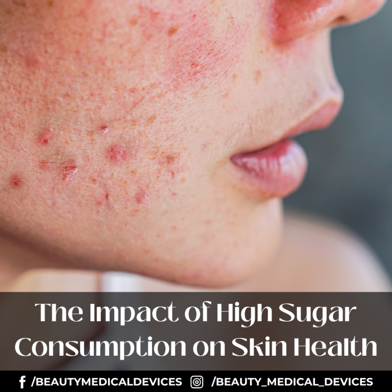 The Impact of High Sugar Consumption on Skin Health